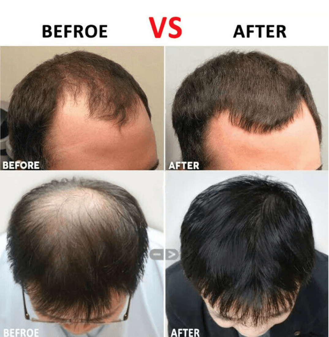 Micro Aiguille À Rouleau Dermique Pour Le Visage Et Les Cheveux