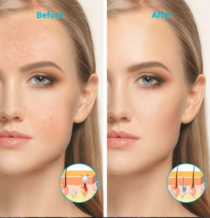 Kit De Luminothérapie Lightstim Acne