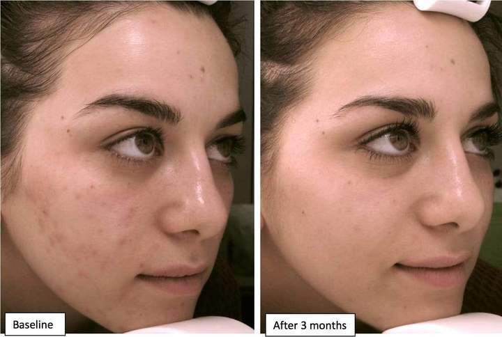 Masque Facial Led Photon Therapy