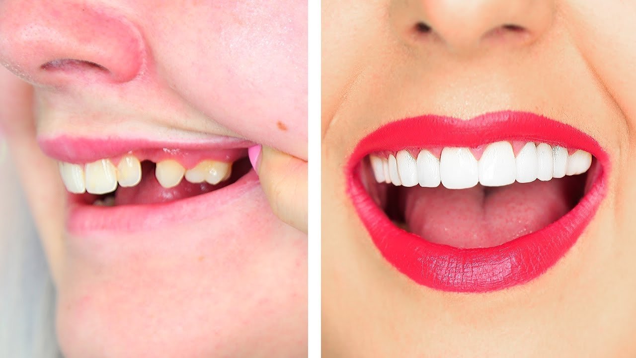Instant Perfect Smile Clip Supérieur Et Inférieur/Encliquetable Sur Les Facettes Pour Des Dents Parfaites Comme Une Célébrité