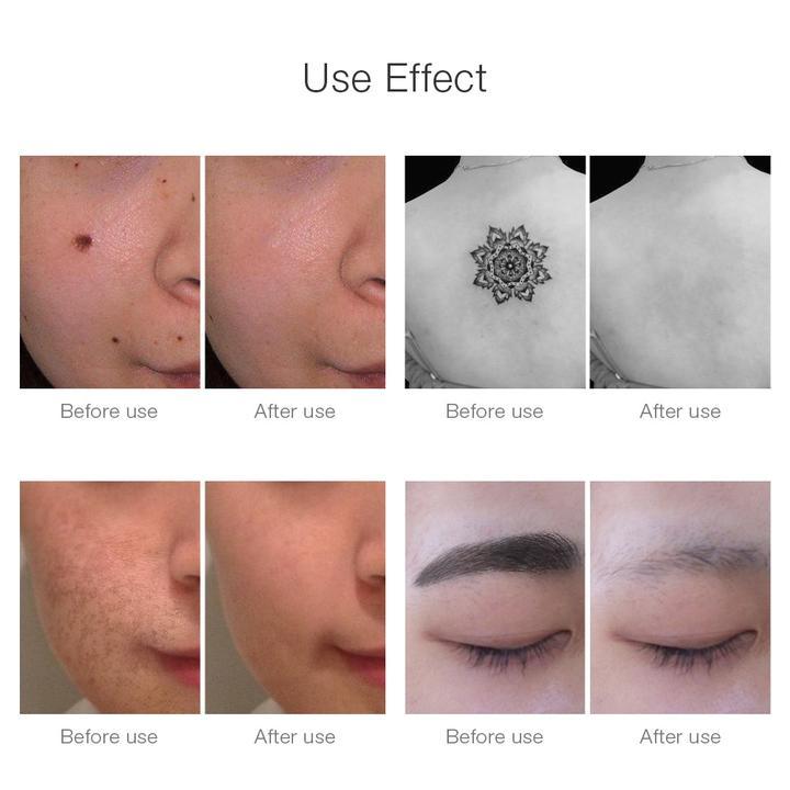 Machine D'Elimination De Tatouage Au Stylo Laser Picosecond